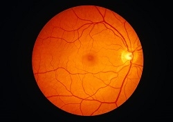No diabetic retinopathy