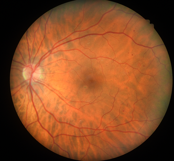 Eye screening showing signs of background retinopathy.