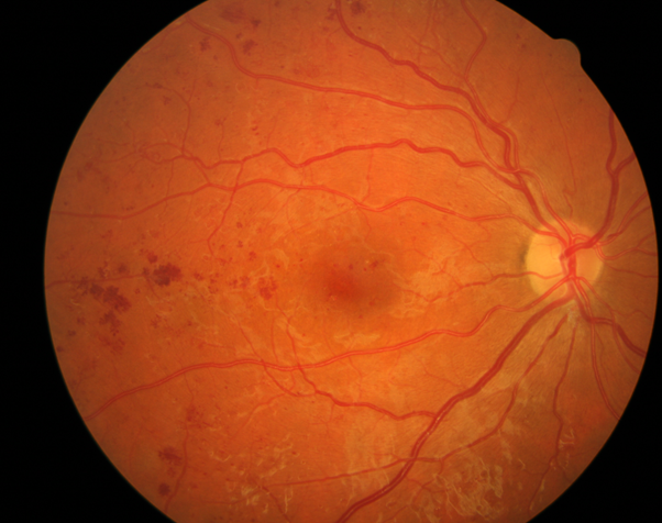 Pre-proliferative retinopathy