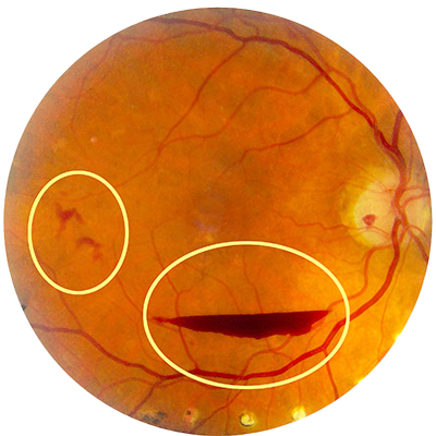 Eye screening results showing signs of proliferative retinopathy.