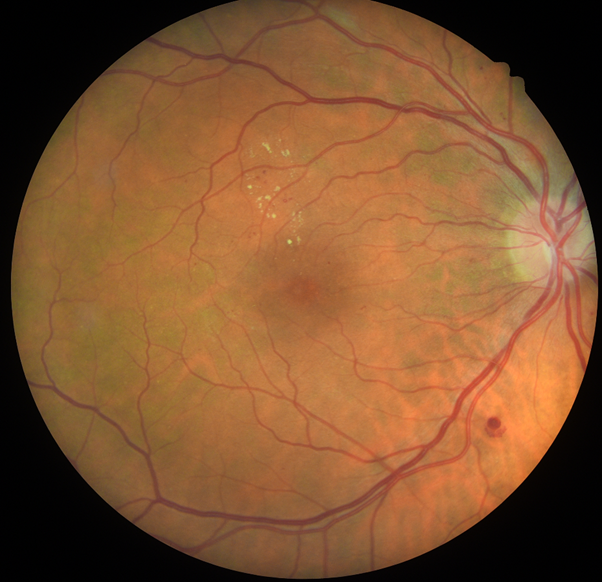 Eye screening showing diabetic maculopathy.