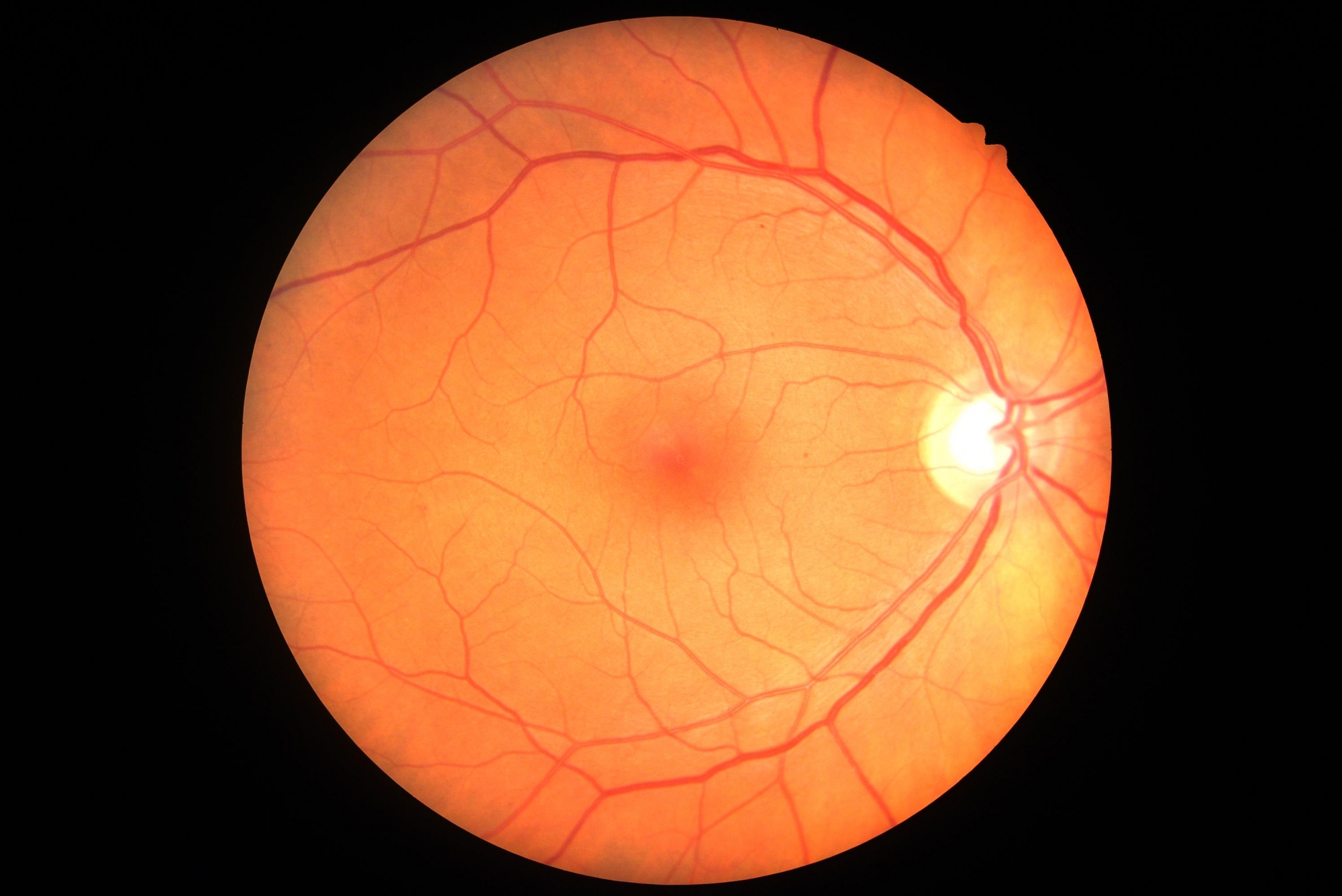 Eye screening test results showing background retinopathy.