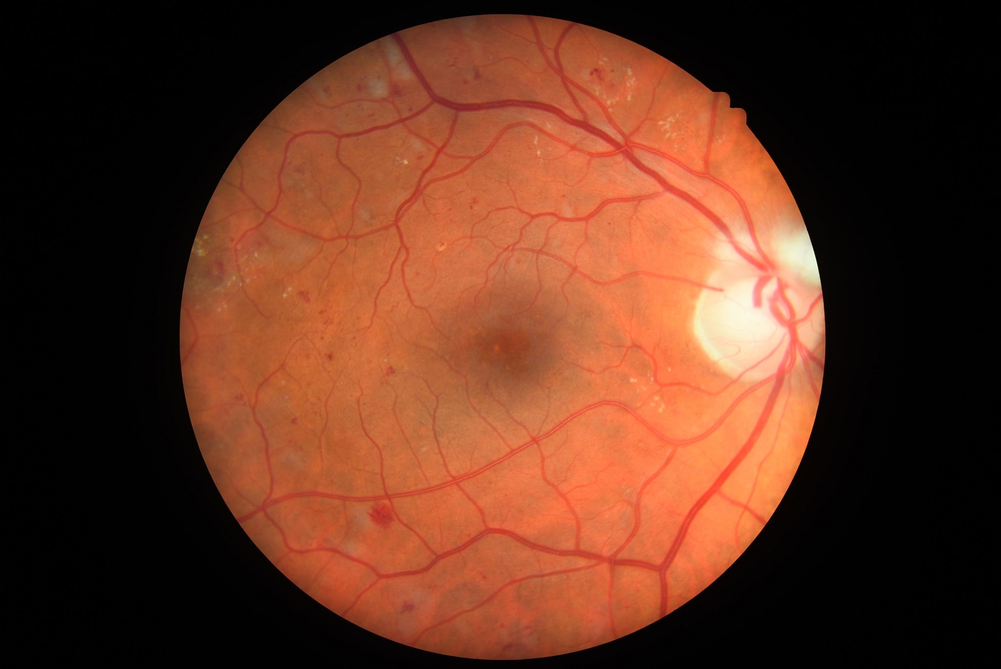 Eye screening test result showing pre-proliferative retinopathy.