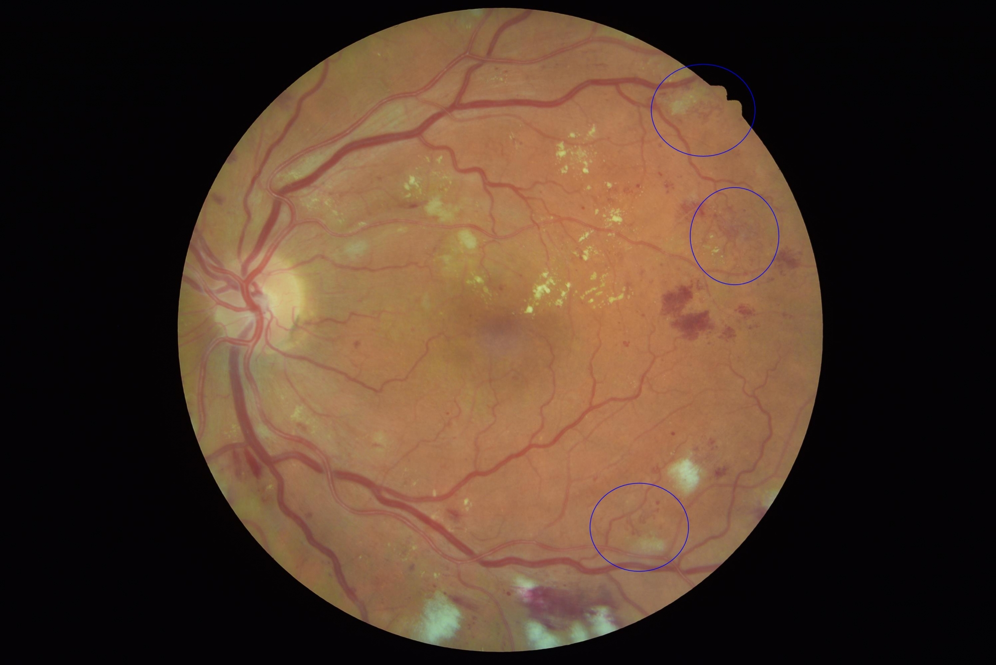 Retina screening test showing proliferative retinopathy.