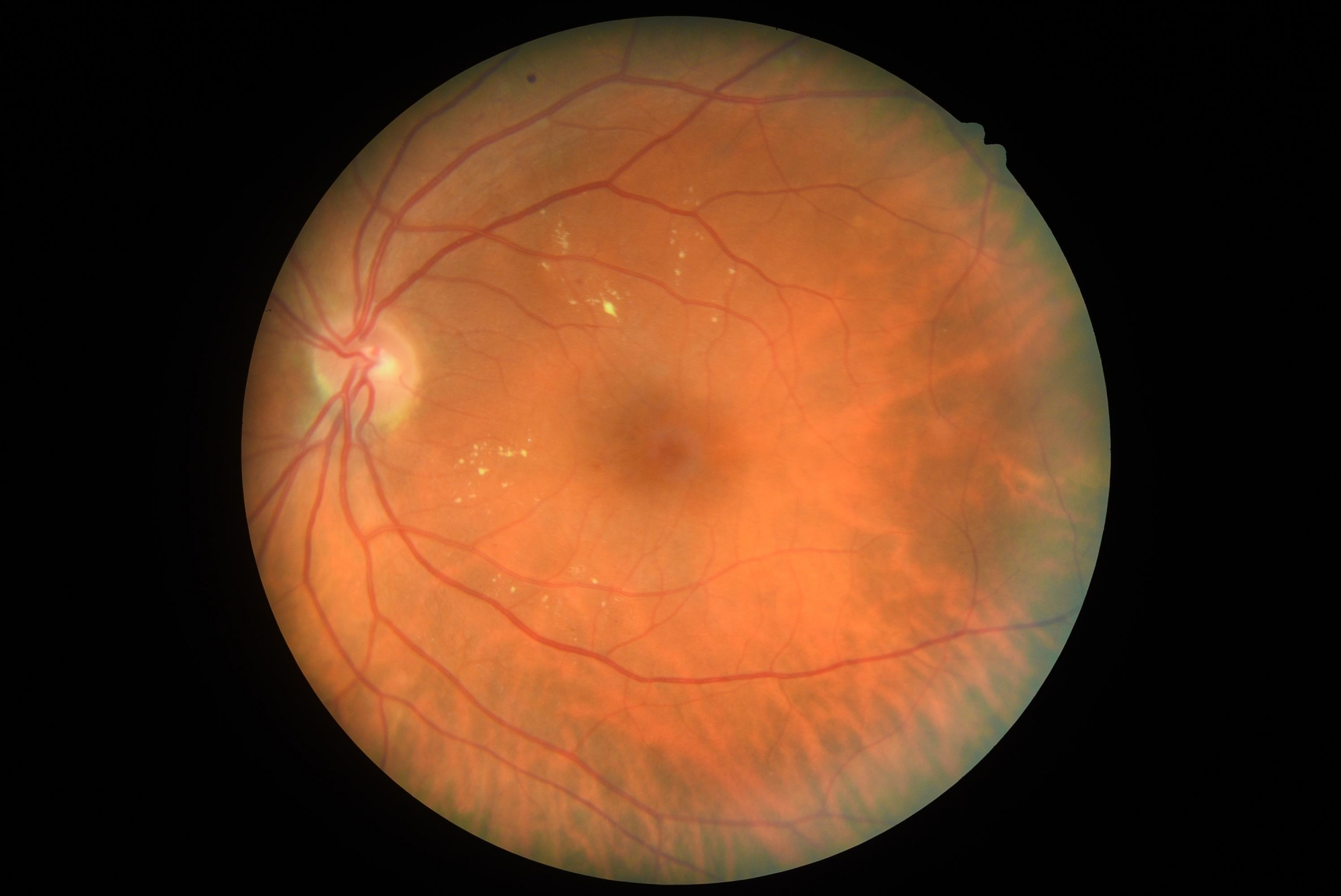 Eye screening showing retina with diabetic maculopathy.